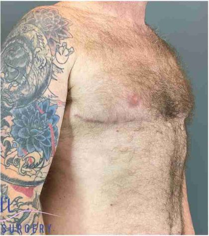 Gynecomastia Before & After Patient #560