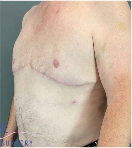 Gynecomastia Before & After Patient #571