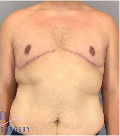 Gynecomastia Before & After Patient #582
