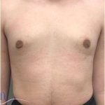 Gynecomastia Before & After Patient #593