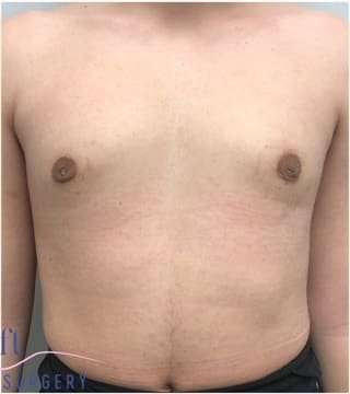 Gynecomastia Before & After Patient #593