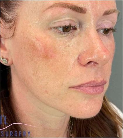 Injectables&Fillers Before & After Patient #118