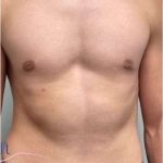 Gynecomastia Before & After Patient #604
