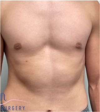 Gynecomastia Before & After Patient #604