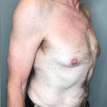 Gynecomastia Before & After Patient #611