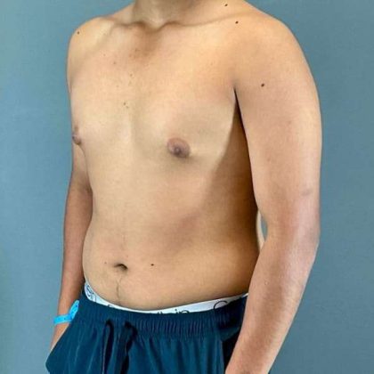 Gynecomastia Before & After Patient #622