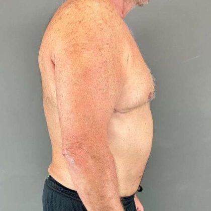 Gynecomastia Before & After Patient #629