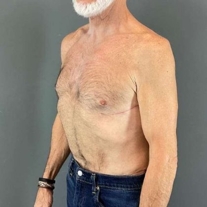 Gynecomastia Before & After Patient #642