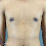 Gynecomastia Before & After Patient #653