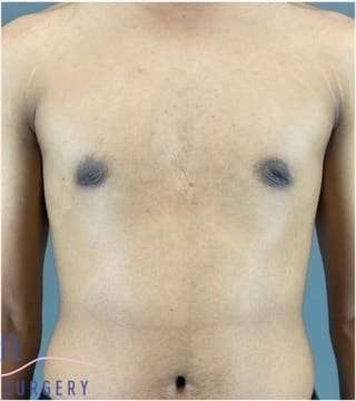 Gynecomastia Before & After Patient #653
