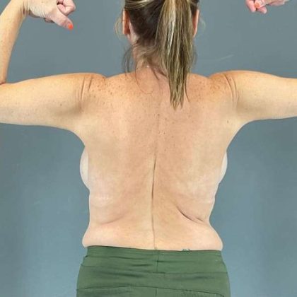 Arm Lift Before & After Patient #210