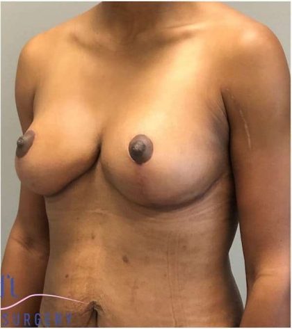 Breast Reduction Before & After Patient #686