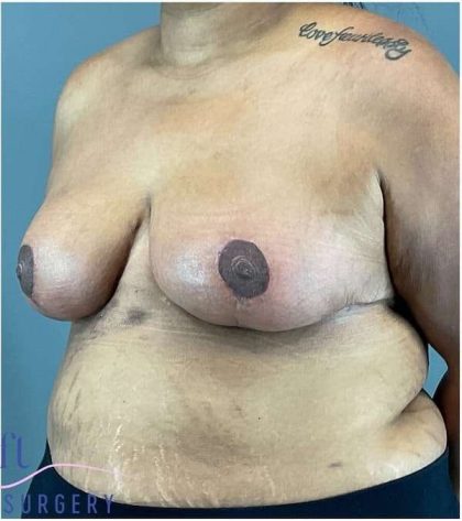 Breast Reduction Before & After Patient #708