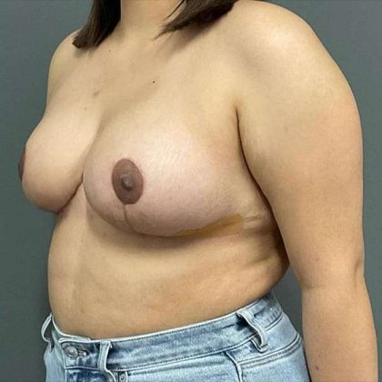 Breast Reduction Before & After Patient #719