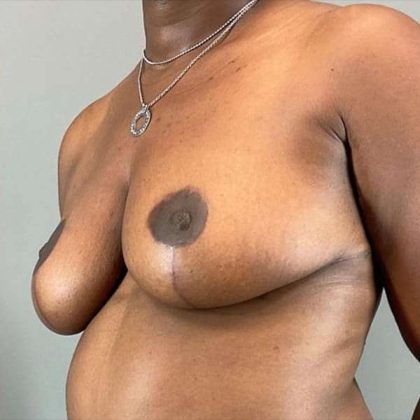 Breast Reduction Before & After Patient #730