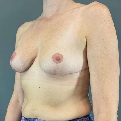 Breast Reduction Before & After Patient #741