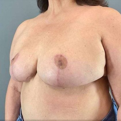 Breast Reduction Before & After Patient #763