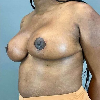 Breast Reduction Before & After Patient #774