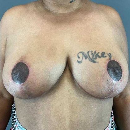 Breast Reduction Before & After Patient #792