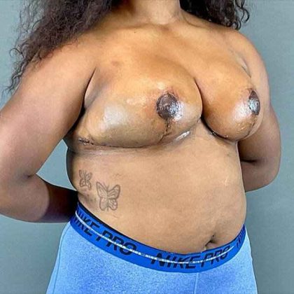 Breast Reduction Before & After Patient #810