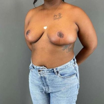 Breast Reduction Before & After Patient #828