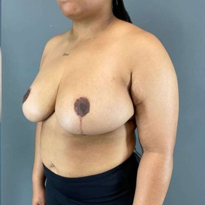 Breast Reduction Before & After Patient #850