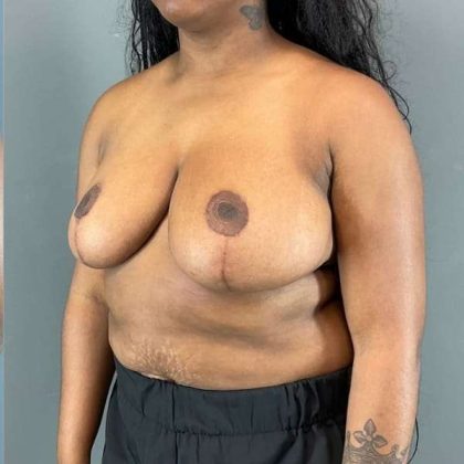 Breast Reduction Before & After Patient #861