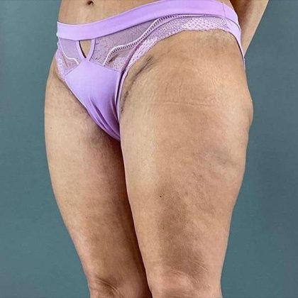 Thigh Lift Before & After Patient #233