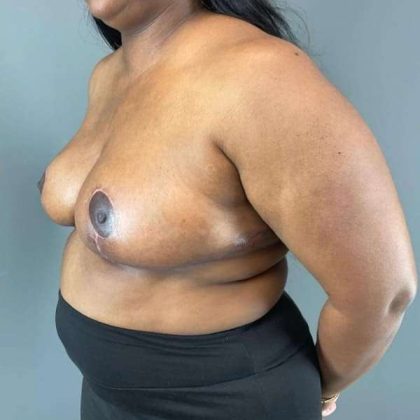 Breast Reduction Before & After Patient #883
