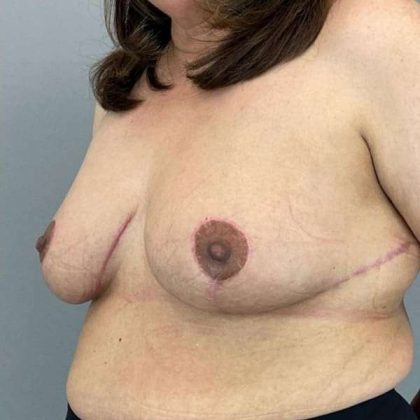 Breast Reduction Before & After Patient #894