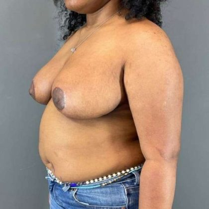 Breast Reduction Before & After Patient #916