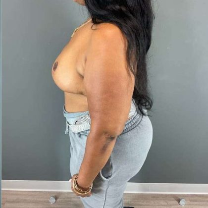Breast Reduction Before & After Patient #927