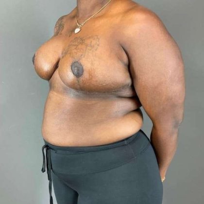 Breast Reduction Before & After Patient #938