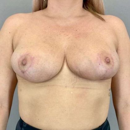 Breast Reduction Before & After Patient #956
