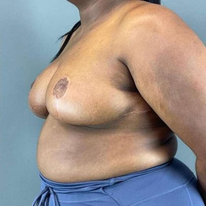 Breast Reduction Before & After Patient #978