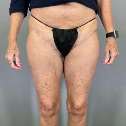 Thigh Lift Before & After Patient #240