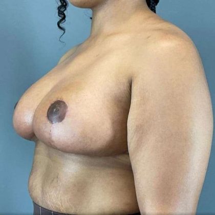 Breast Reduction Before & After Patient #998