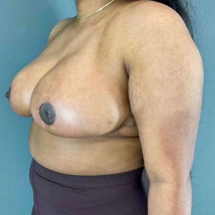 Breast Reduction Before & After Patient #1018