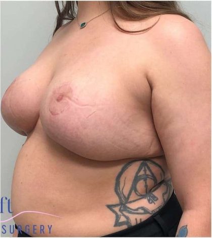 Breast Reduction Before & After Patient #1029