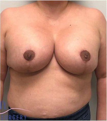 Breast Lift Before & After Patient #1040