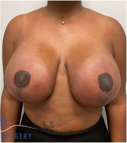 Breast Lift Before & After Patient #1051