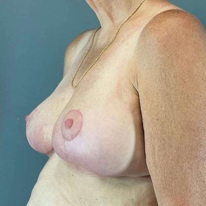 Breast Lift Before & After Patient #1062