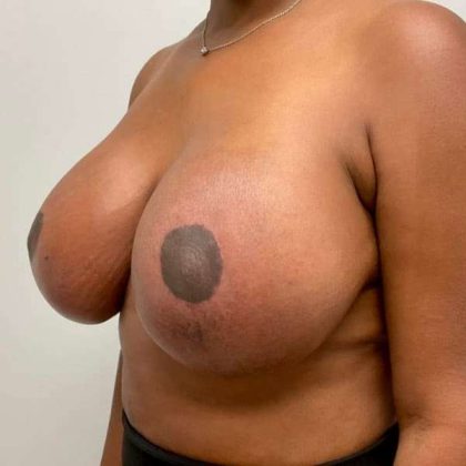 Breast Lift Before & After Patient #1084