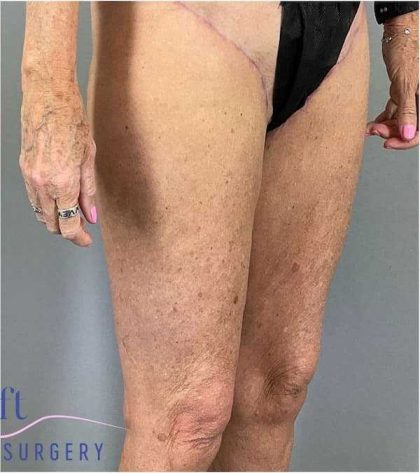 Thigh Lift Before & After Patient #247