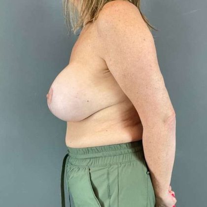 Breast Lift Before & After Patient #1091