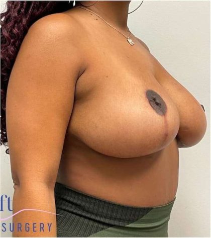 Breast Lift Before & After Patient #1098