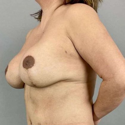 Breast Lift Before & After Patient #1120
