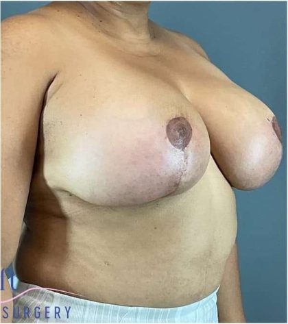 Breast Lift Before & After Patient #1131