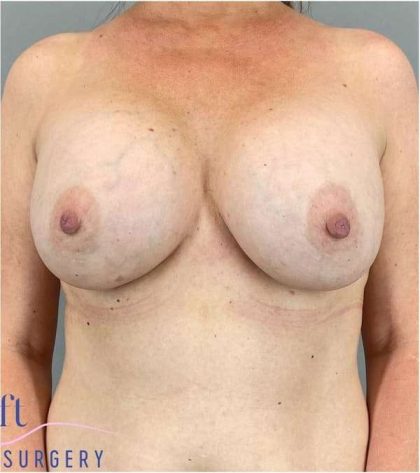 Breast Implant Exchange Before & After Patient #1142