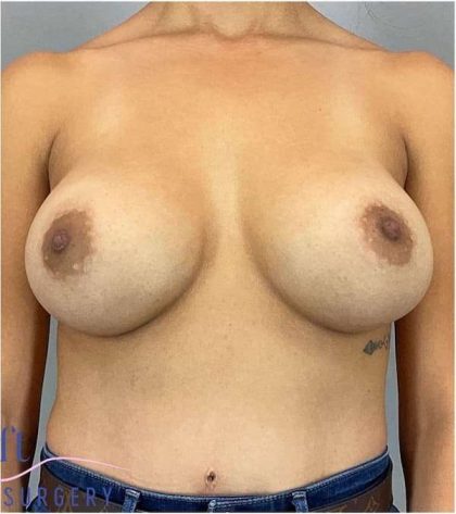 Breast Implant Exchange Before & After Patient #1164